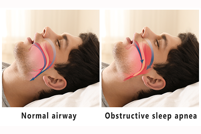 Obstructive Sleep Apnoea