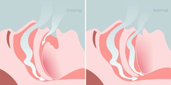 Why Do People Snore? - Causes of Snoring & The Link to Sleep Apnoea ...